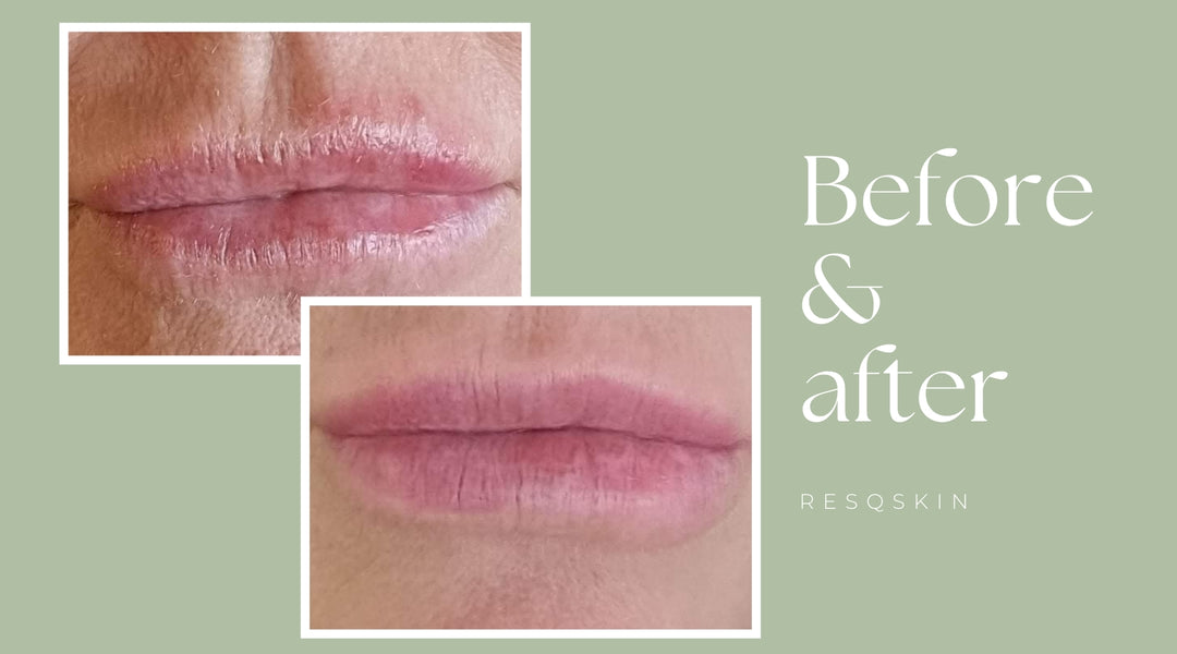 Before and after using ResQ Skin Rapid Relief Cream for treating Eczema.