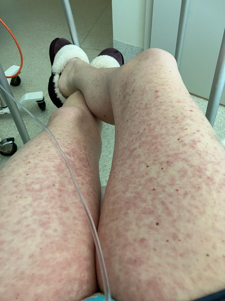 Females legs covered in GvHD rash