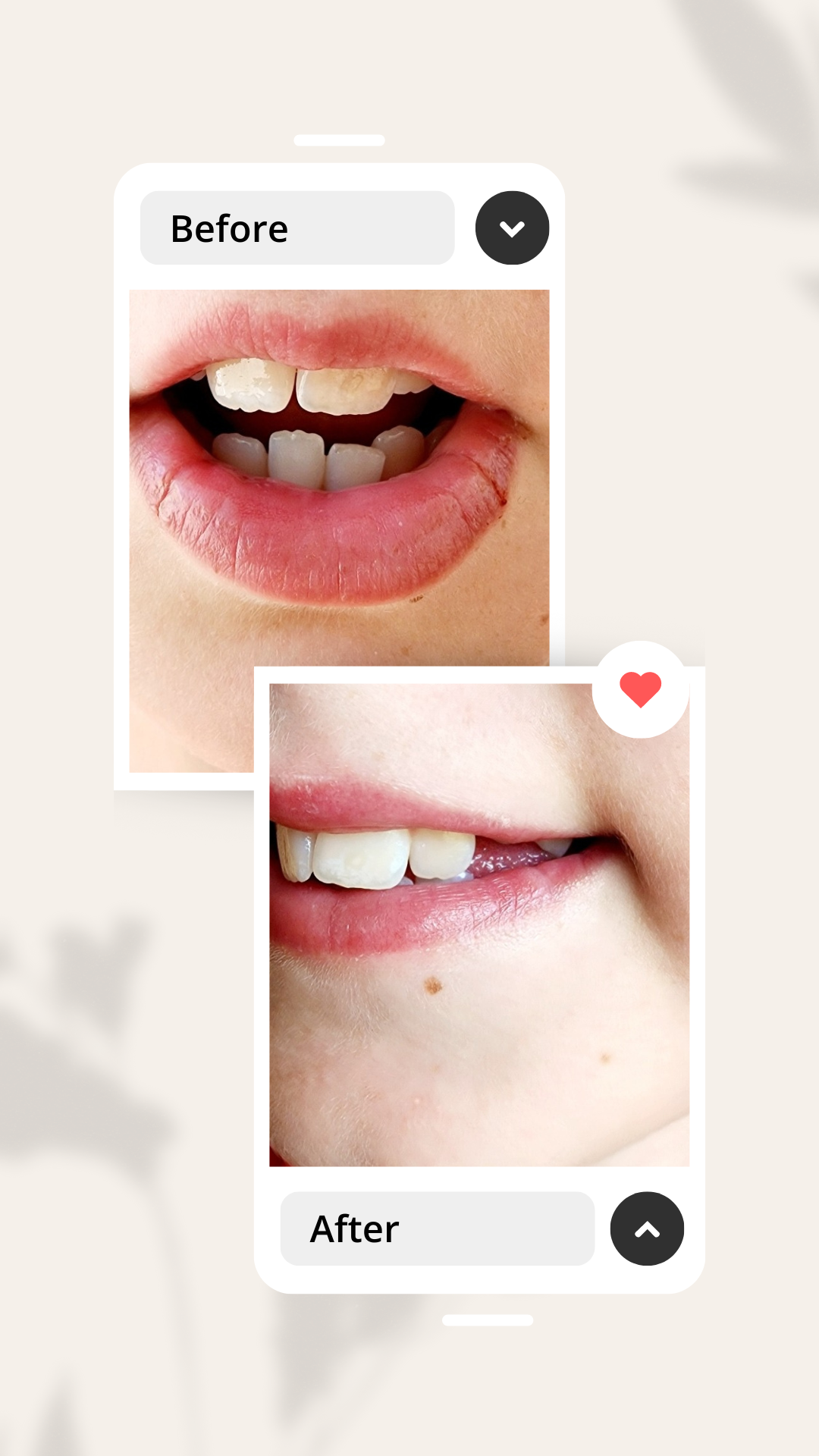 Before and after image of girl with split lips